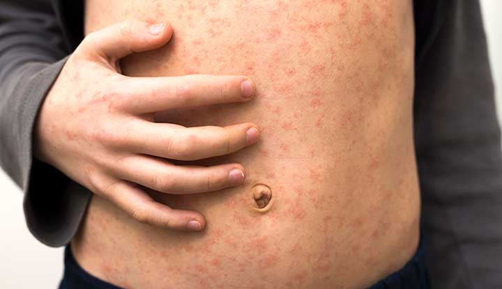 Ảnh một em bé bị sởi với các nốt ban trên bụng, minh họa triệu chứng phát ban của bệnh.