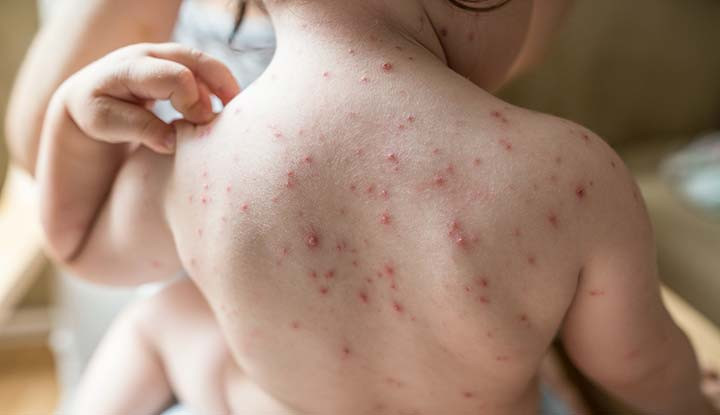 Hình ảnh bệnh thủy đậu với các nốt mụn nước đặc trưng.