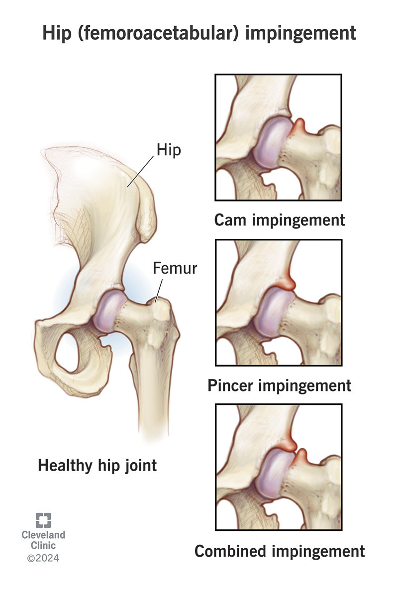 Hình ảnh khớp háng khỏe mạnh và các dạng chèn ép khớp háng: cam, pincer, hỗn hợp