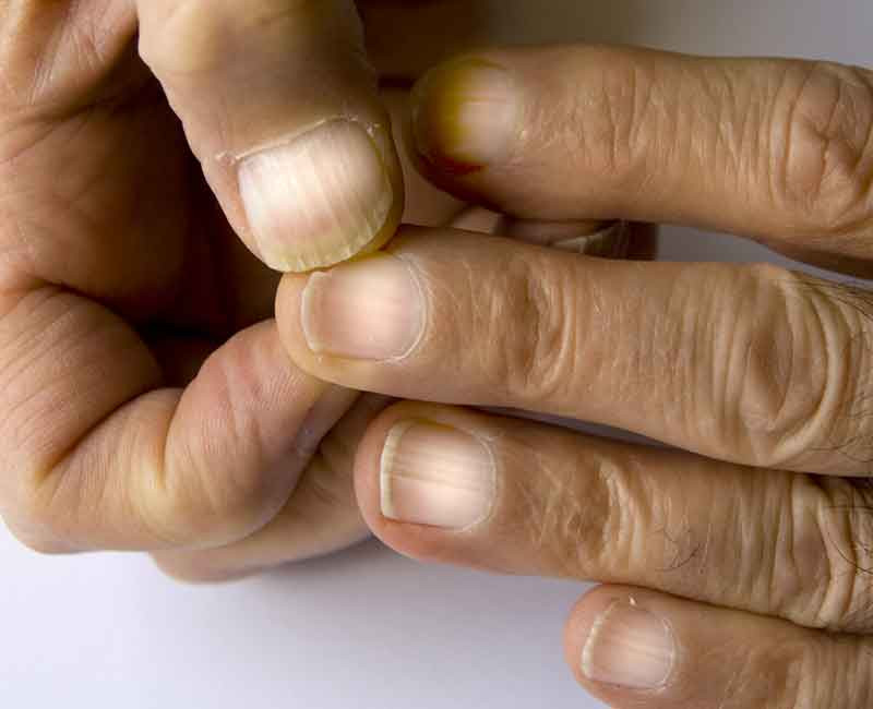Móng tay Terry có dạng như thủy tinh mờ, không có hình bán nguyệt gần lớp biểu bì và có một dải màu nâu gần đầu móng.