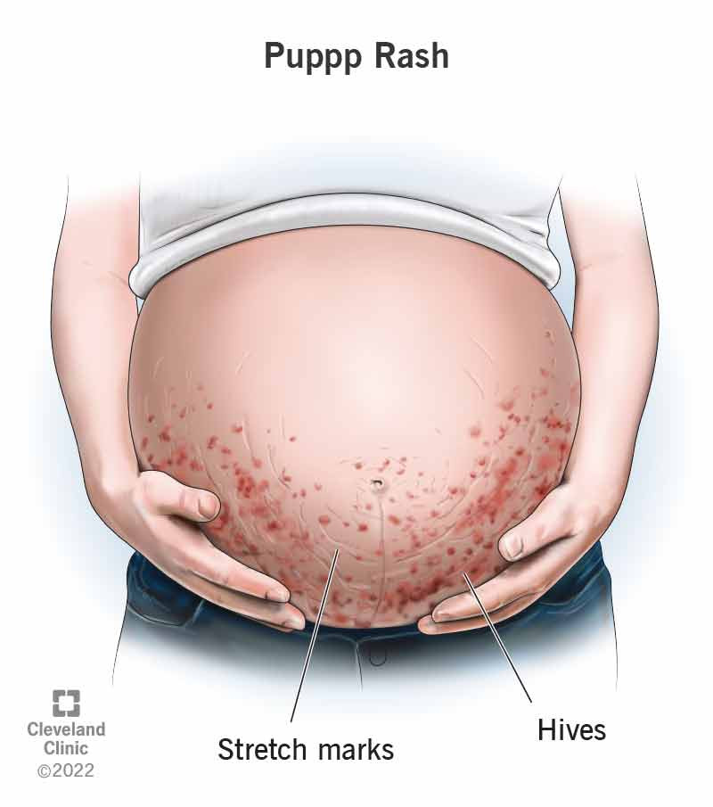 Phát ban PUPPP trên bụng bà bầu