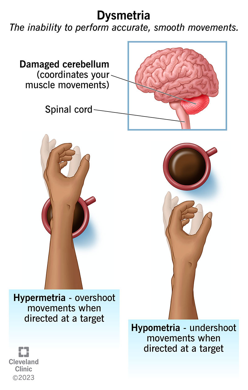 Rối loạn đo khoảng cách: một bàn tay vượt quá (hypermetria) và không tới (hypometria) khi với lấy một tách cà phê.
