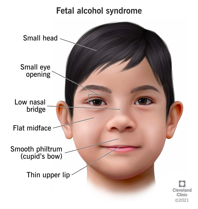 Trẻ sơ sinh mắc hội chứng nghiện rượu bào thai (FAS) có các đặc điểm khuôn mặt đặc trưng